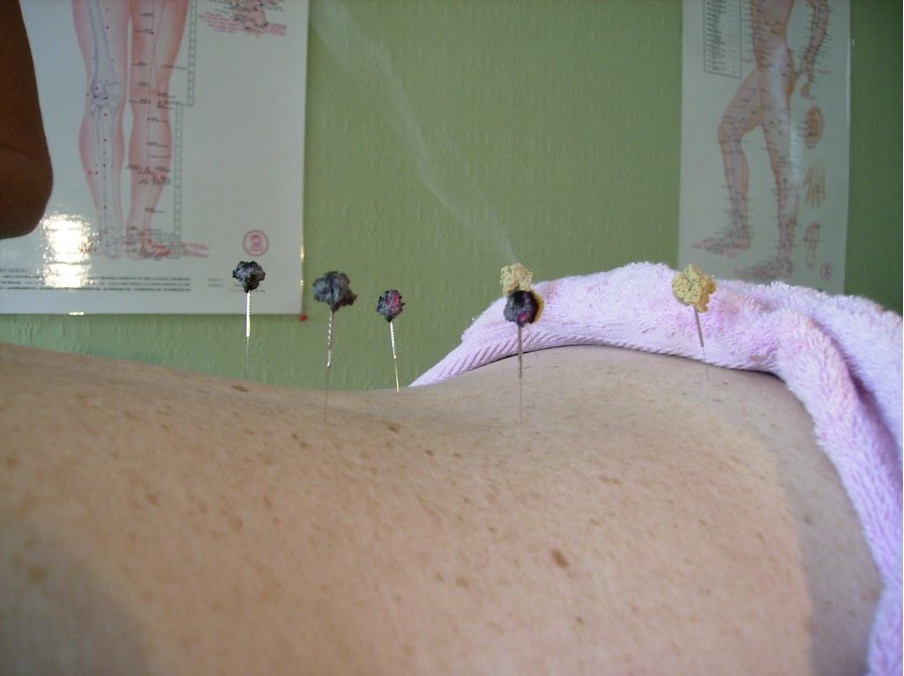 Boulettes de moxa piquées sur des aiguilles d’acupuncture.